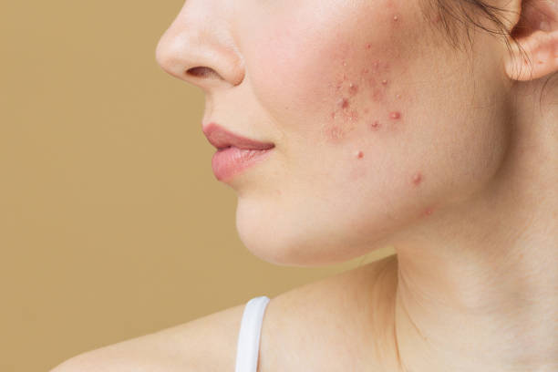 Dealing with Acne After Giving Birth with 8 Simple Tips